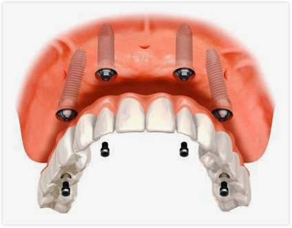 Dental Implants for Patients with Anxiety