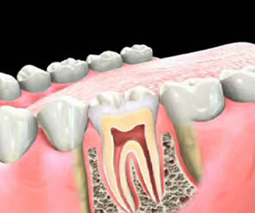 Delving into Root Canal Treatment
