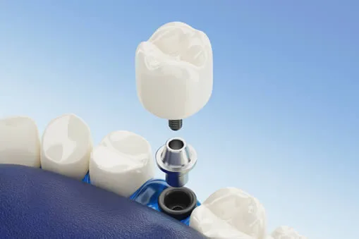 dental implant in mouth illustration